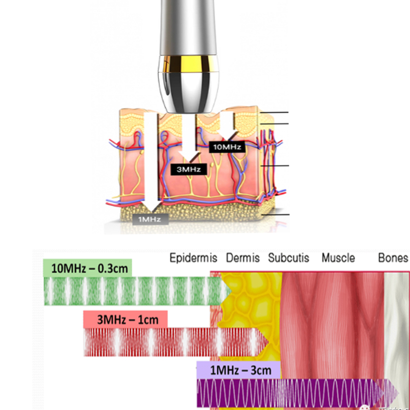 O instrumento de beleza ultrassônico de 10 MHz desenvolvido pela empresa